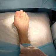 «Косточка» на ноге (Hallux valgus)